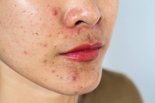 Hormonal Acne vs. Regular Acne: What's The Difference?