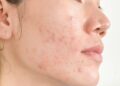 Adult Hormonal Acne - Causes, Triggers and Treatments – Skinmart