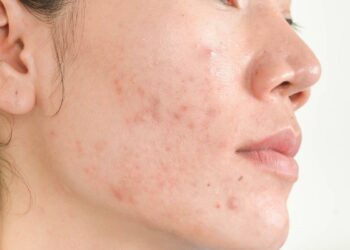 Adult Hormonal Acne - Causes, Triggers and Treatments – Skinmart