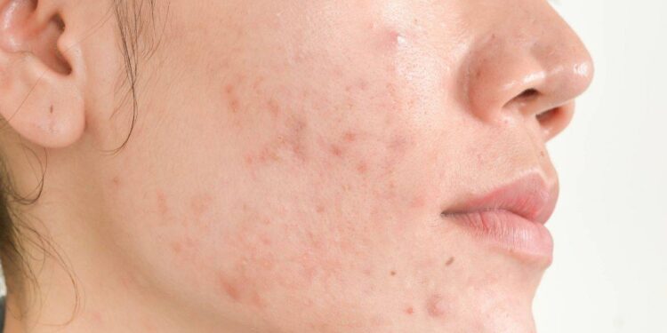 Adult Hormonal Acne - Causes, Triggers and Treatments – Skinmart