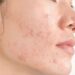 Adult Hormonal Acne - Causes, Triggers and Treatments – Skinmart